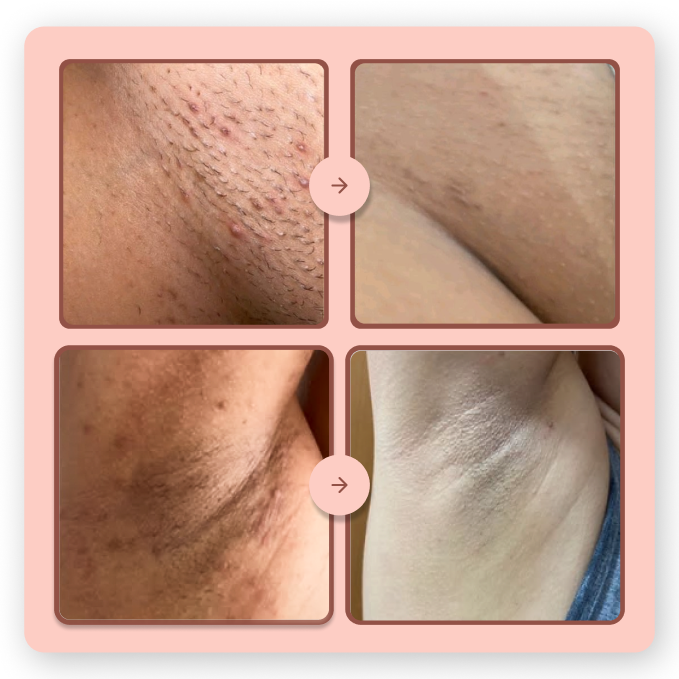 1 Depilador Elétrico Anti Foliculite